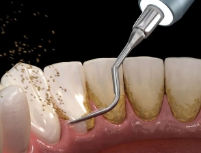 Cạo Vôi Răng Gói Số 2